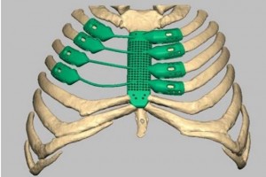 3D titanium ribs